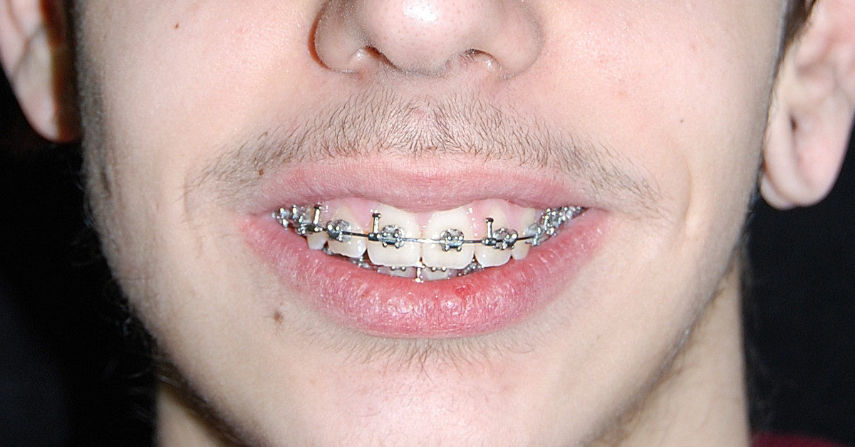 Apparecchi ortodontici fissi brackets in metallo